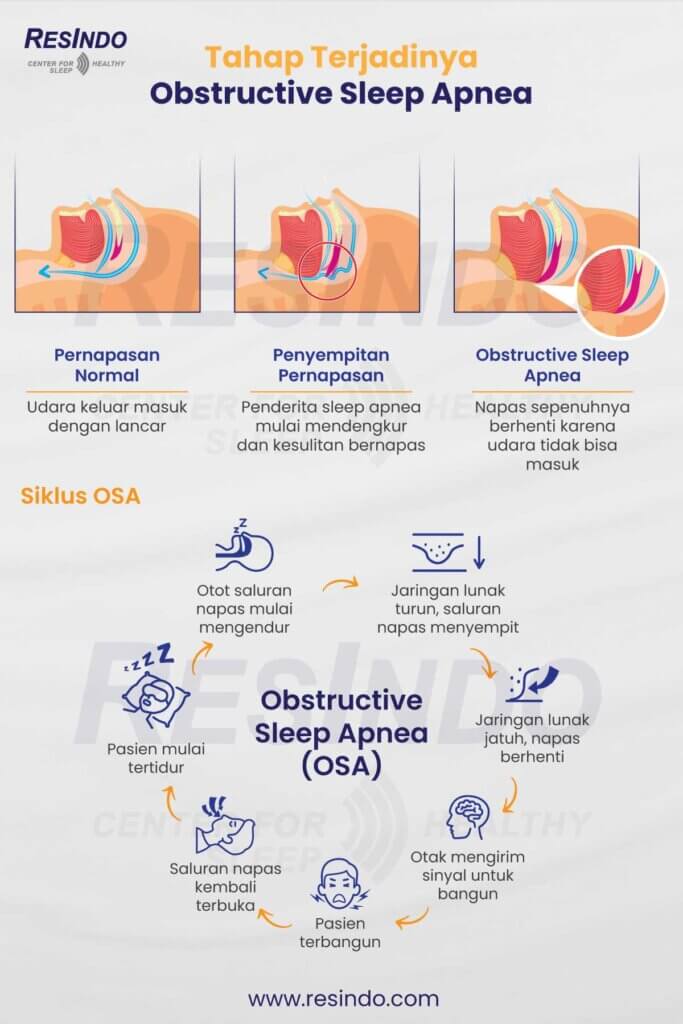 tahapan-terjadinya-obstruktive-sleep-apnea-OSA-atau-patofisiologi-OSA